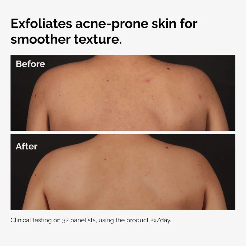 Salicylic Acid 0.5% Body Serum - Image 4